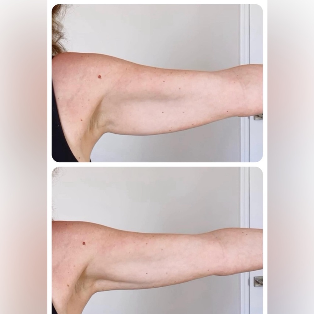 RENU SPA HEALTH WELLNESS CELLULITE IRON